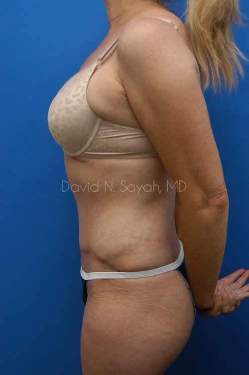 Tummy Tuck Before and After | Sayah Institute