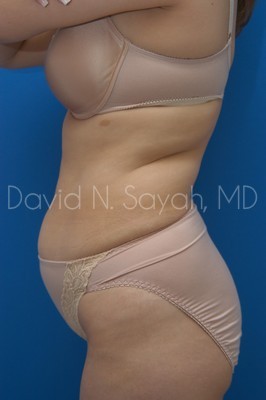 Tummy Tuck Before and After | Sayah Institute