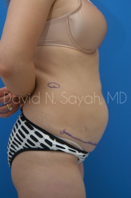 Tummy Tuck Before and After | Sayah Institute