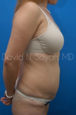 Tummy Tuck Before and After | Sayah Institute