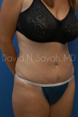 Tummy Tuck Before and After | Sayah Institute