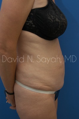 Tummy Tuck Before and After | Sayah Institute