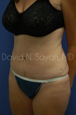 Tummy Tuck Before and After | Sayah Institute