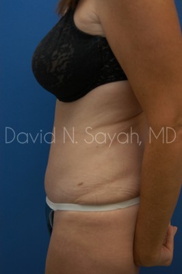 Tummy Tuck Before and After | Sayah Institute