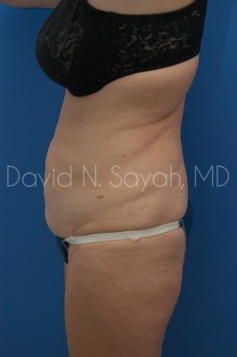 Tummy Tuck Before and After | Sayah Institute