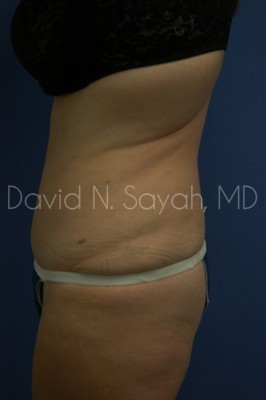 Tummy Tuck Before and After | Sayah Institute