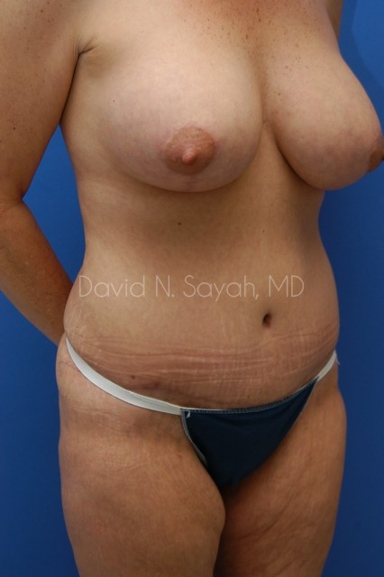 Tummy Tuck Before and After | Sayah Institute