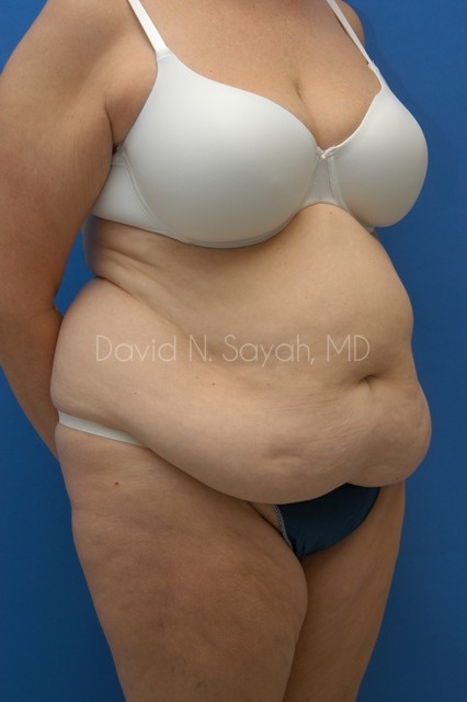 Tummy Tuck Before and After | Sayah Institute
