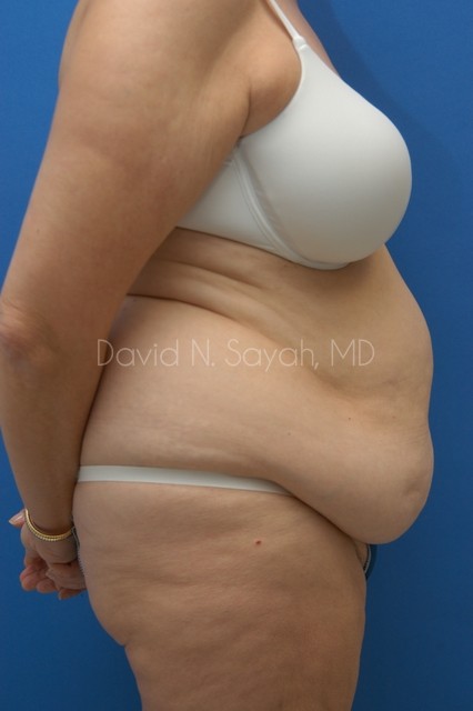 Tummy Tuck Before and After | Sayah Institute