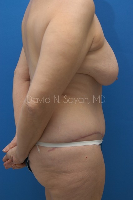 Tummy Tuck Before and After | Sayah Institute