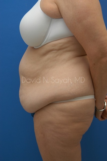Tummy Tuck Before and After | Sayah Institute