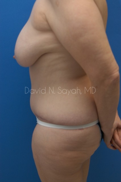 Tummy Tuck Before and After | Sayah Institute
