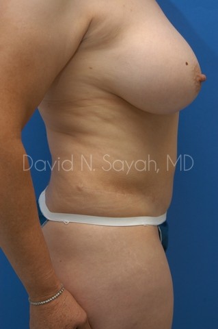 Tummy Tuck Before and After | Sayah Institute