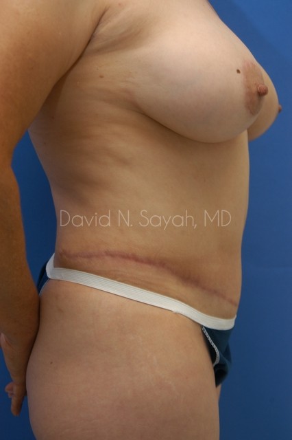Tummy Tuck Before and After | Sayah Institute