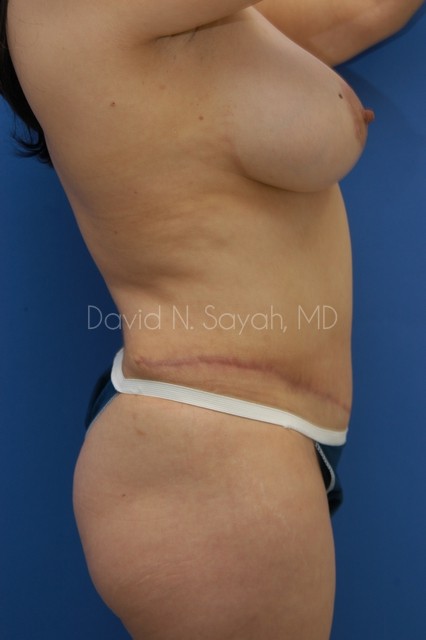 Tummy Tuck Before and After | Sayah Institute