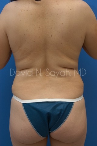 Tummy Tuck Before and After | Sayah Institute