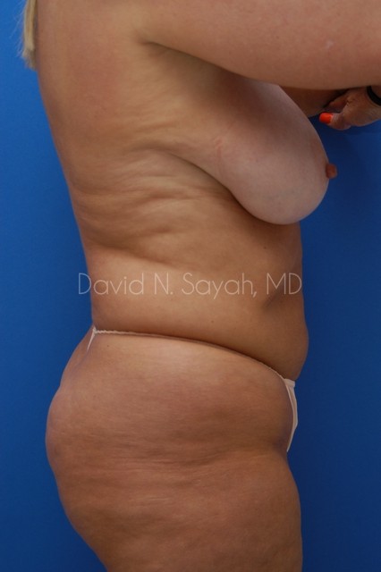 Tummy Tuck Before and After | Sayah Institute