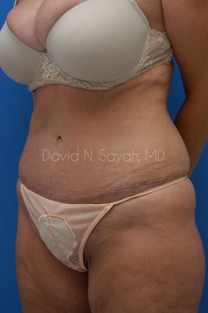 Tummy Tuck Before and After | Sayah Institute