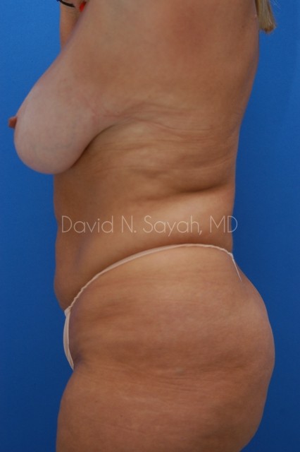 Tummy Tuck Before and After | Sayah Institute