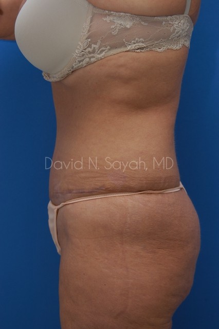 Tummy Tuck Before and After | Sayah Institute