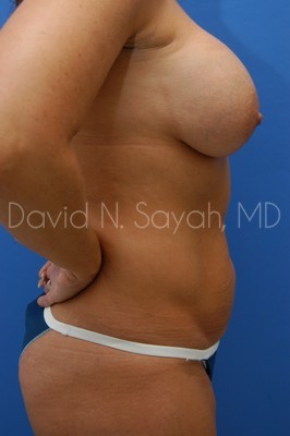Tummy Tuck Before and After | Sayah Institute