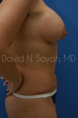Tummy Tuck Before and After | Sayah Institute