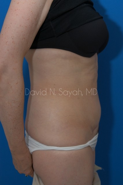 Tummy Tuck Before and After | Sayah Institute