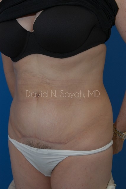 Tummy Tuck Before and After | Sayah Institute