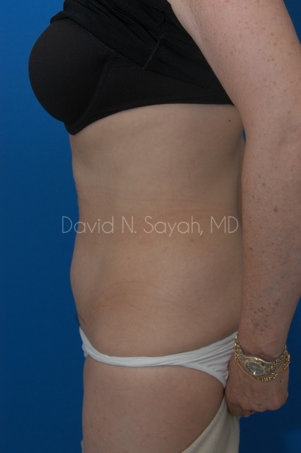 Tummy Tuck Before and After | Sayah Institute