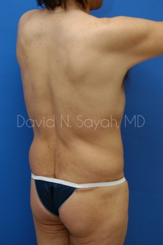 Tummy Tuck Before and After | Sayah Institute