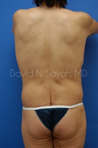 Tummy Tuck Before and After | Sayah Institute