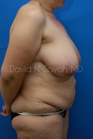 Tummy Tuck Before and After | Sayah Institute