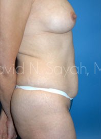 Tummy Tuck Before and After | Sayah Institute